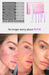 Violet Ray Acne Remover