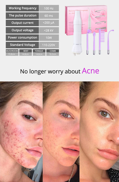 Violet Ray Acne Remover