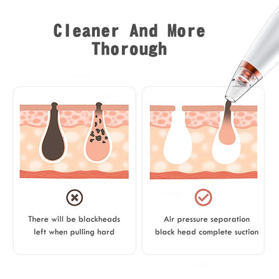 Blackhead Remover Tool