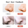 Blackhead Remover Tool