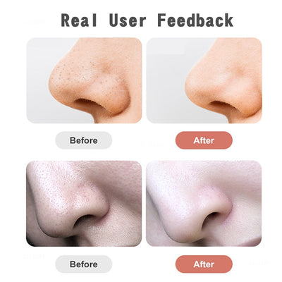 Blackhead Remover Tool