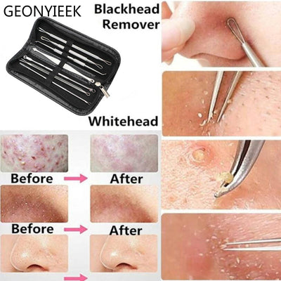 Stainless Steel Blackhead Remover